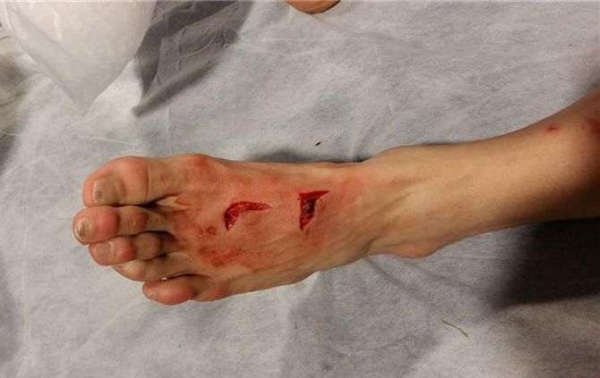 Porto, 17 punti di sutura al piede di Herrera per un fallo di Lichtsteiner preview