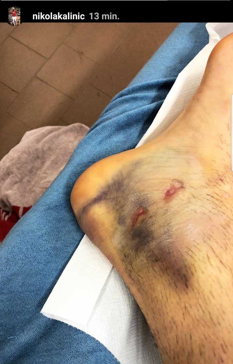 Kalinic ko dopo il fallo di Skriniar: ecco le condizioni della sua caviglia. La foto preview