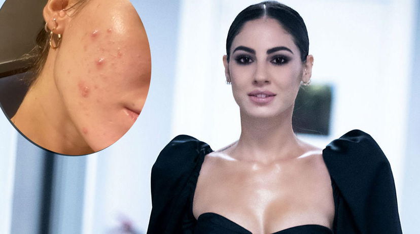 Giulia De Lellis mostra i suoi problemi con l’acne e si sfoga: “Nessuna cura funziona” preview