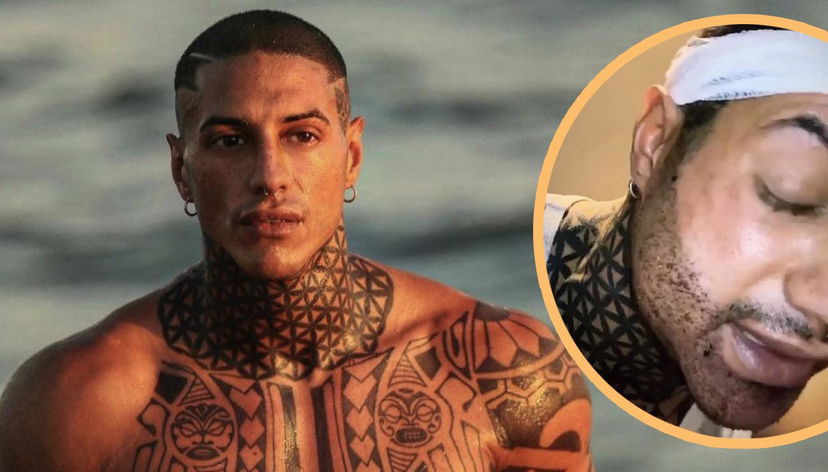 Francesco Chiofalo si mostra dopo l’intervento chirurgico al volto (ma è deluso): “Sto male sono cambiato in peggio” preview