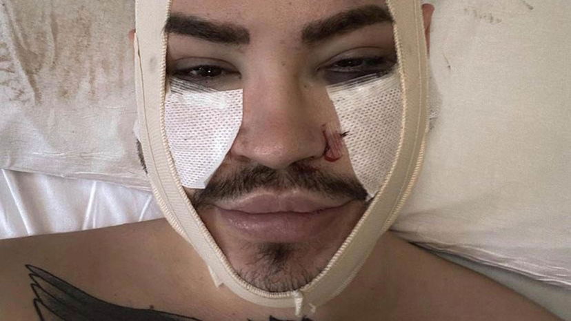 Cristian Imparato si è fatto la liposuzione al volto per togliere il filler preview