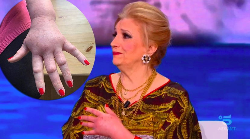Iva Zanicchi con la mano gonfia, come sta adesso dopo la puntura di vespa preview