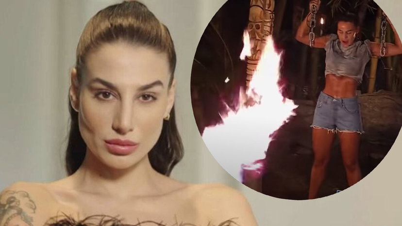 Patrizia Bonetti mostra le ustioni sulla pancia causate dalla prova del fuoco preview