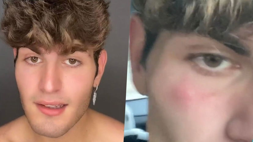 Lorenzo Sabato picchiato da 5 omofobi, il tiktoker racconta: “Botte, sputi e insulti in discoteca” preview