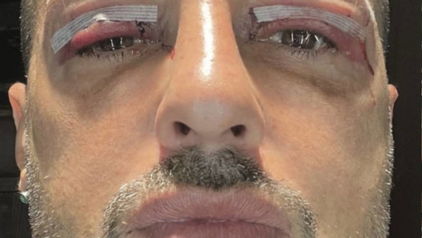 Blefaroplastica, Corona si sottopone all’intervento e attacca Garko: “Ha un anno più di me ma sembra una vecchia rifatta” preview