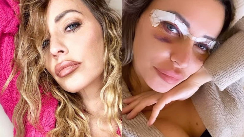 Karina Cascella si è sottoposta all’intervento di blefaroplastica preview