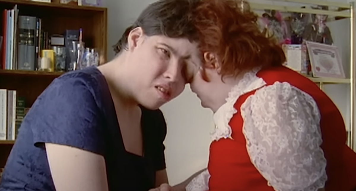 Morti i gemelli siamesi Schappell: uno di loro fece coming out come trans article-post