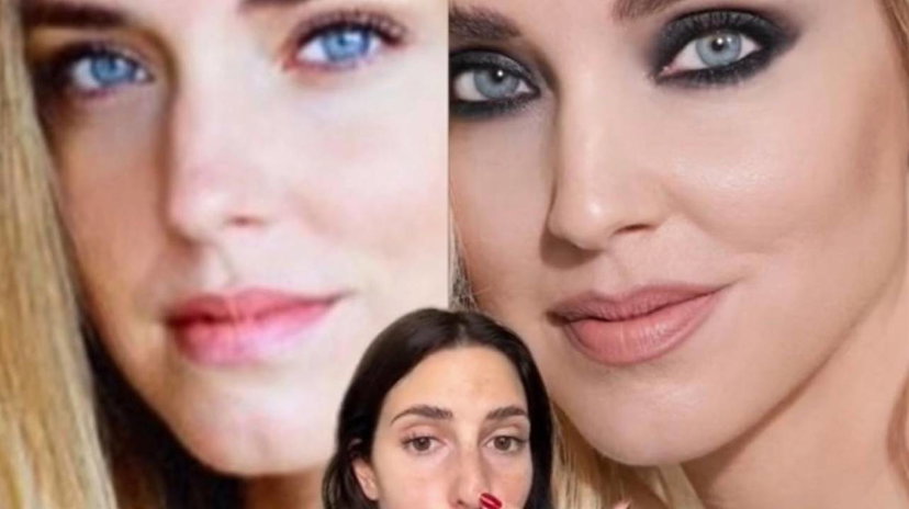 Botox e filler per Chiara Ferragni, parla l’esperta e mostra il prima e il dopo preview