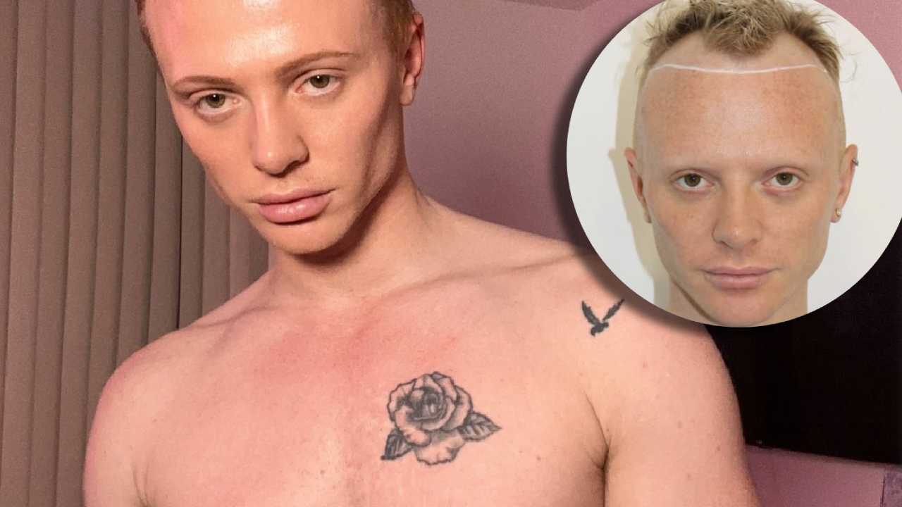 Bimini Bon da Biccy.it Bimini Bon-Boulash | la foto dopo il trapianto di capelli