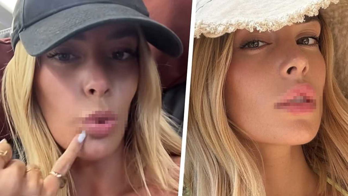 Sophie Codegoni, prima e dopo aver rimosso il filler: “Perché l’ho tolto” article-post