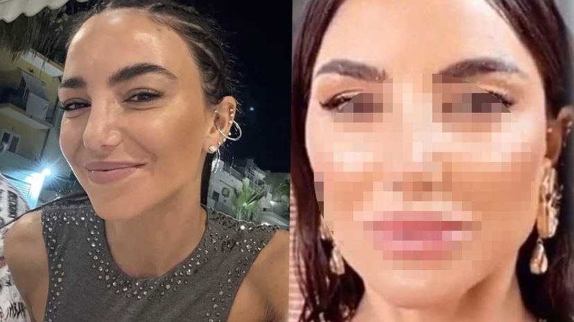 Chiara Biasi rimuove il filler dal volto: “Ero un mostro” preview