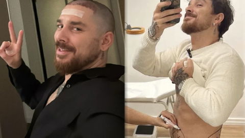 Andrea Cerioli, trapianto di capelli, liposuzione e botox: tutti gli interventi preview