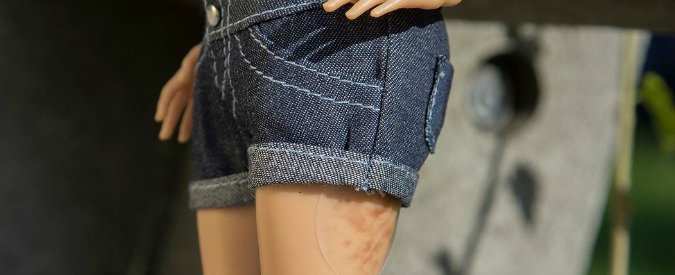 Cellulite E Smagliature A 13 Anni