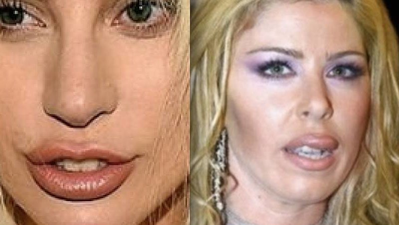 Lady Gaga labbra rifatte 3