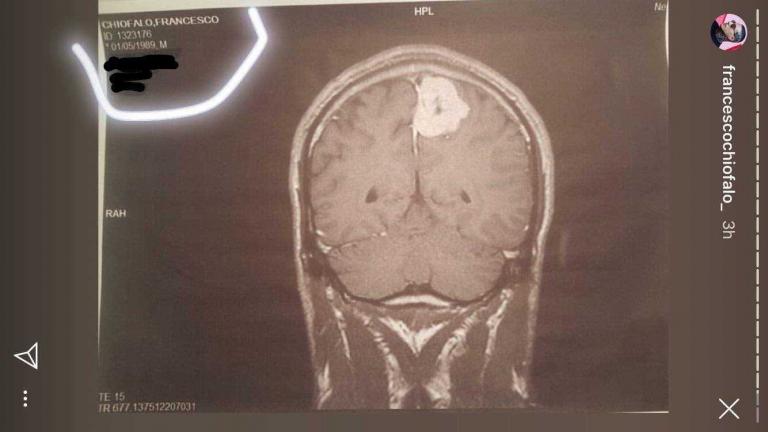 Sognare Di Avere Un Tumore Al Cervello