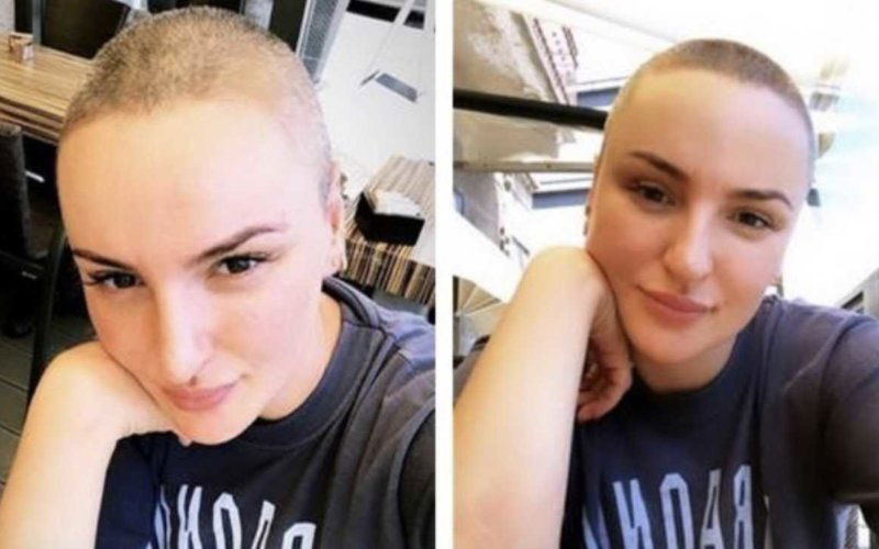 arisa rasata patologia comportamento disturbo capelli look