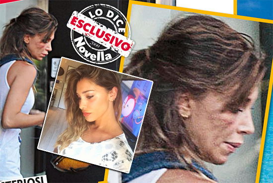 Belen Rodriguez con dei lividi in volto, ritocchino oppure no? Lei smentisce su Instagram: “Giornali spazzatura” preview