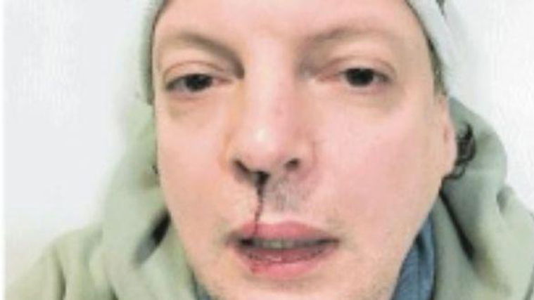 Dado, comico pestato da stalker della figlia: “ha tentato di investirmi, poi mi ha dato un pugno”, foto choc article-post
