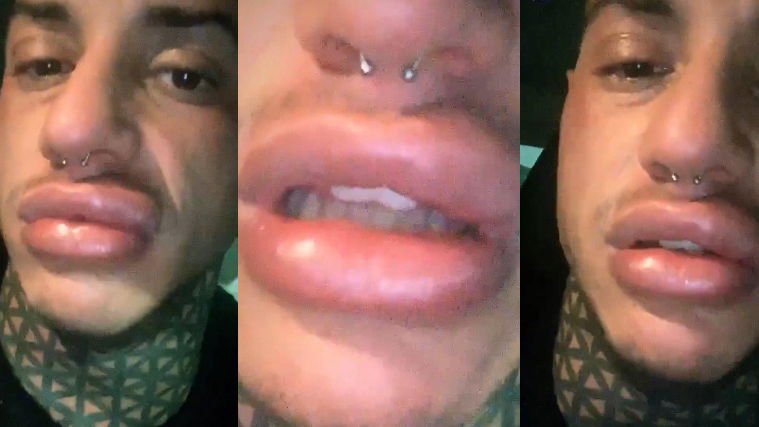 Francesco Chiofalo, come sta? “Labbra ancora gonfie, potrei soffocare” preview