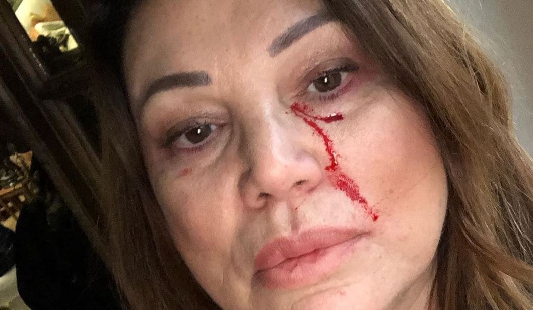 Serena Grandi, sangue sul volto: cosa è successo? La foto “incriminata” article-post