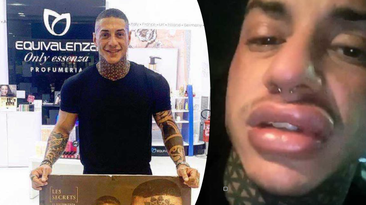 Francesco Chiofalo prende tutti in giro? Labbra sgonfie, le foto che lo dimostrano preview