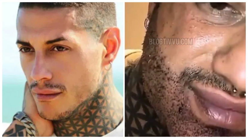 Francesco Chiofalo “sfigurato” dalla chirurgia mostra il volto: “Mi viene un colpo quando mi guardo…” (VIDEO) preview