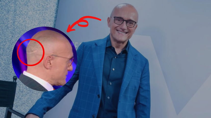 Perché Alfonso Signorini ha una cicatrice in testa? Ecco il motivo: “Non lo rifarei…” preview