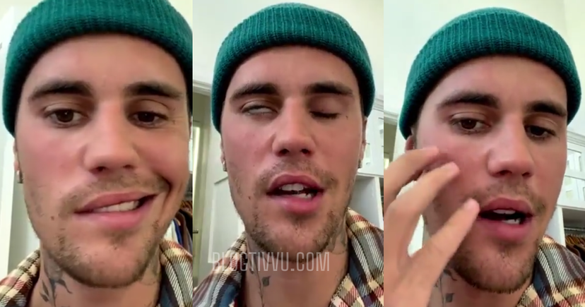 La malattia di Justin Bieber: mezza faccia paralizzata, ecco di cosa si tratta – VIDEO preview