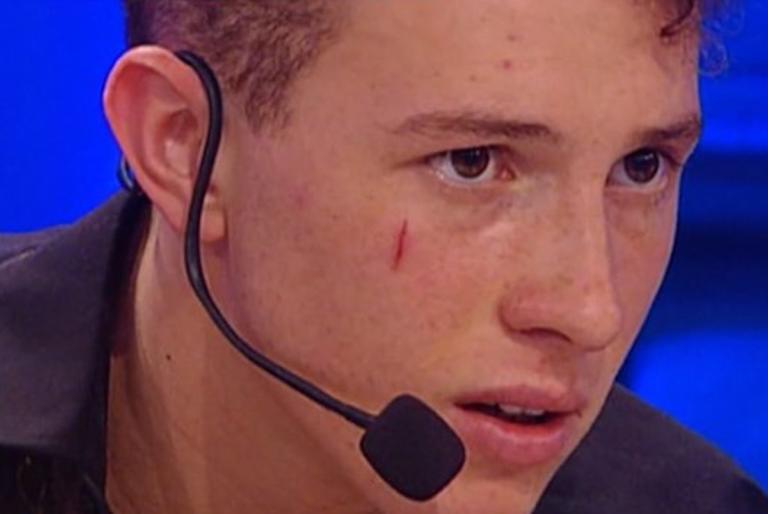 Perché Wax di Amici 22 ha una cicatrice sulla faccia? Il presunto motivo