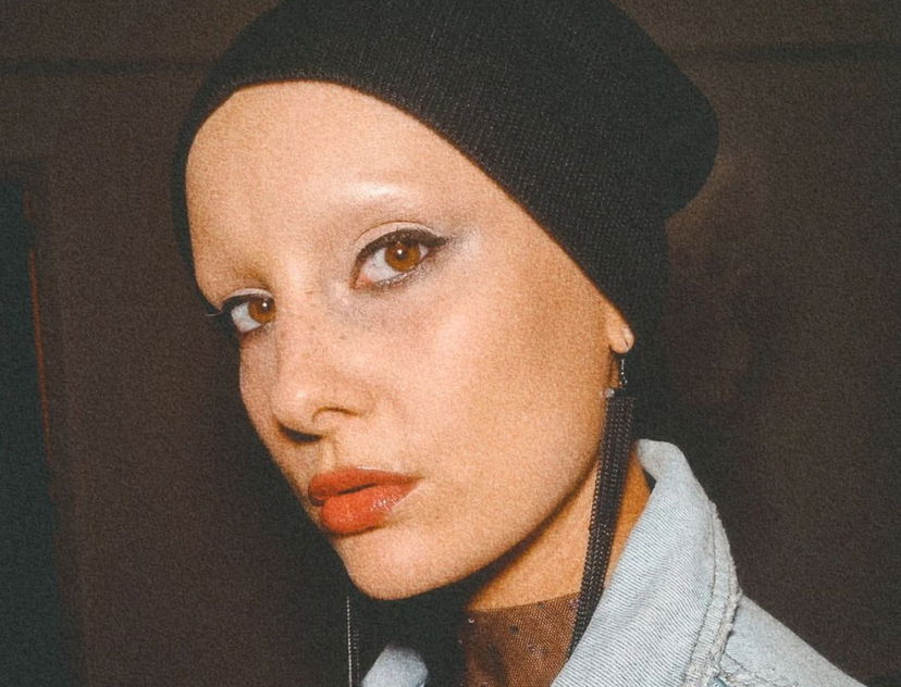 Tricotillomania, qual è la malattia di Sara Meucci (Miss Swirl): sintomi del disturbo preview