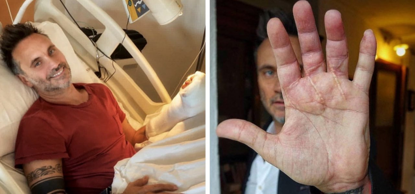 Incidente alla mano di Nek: taglio con la sega circolare, cosa è successo preview