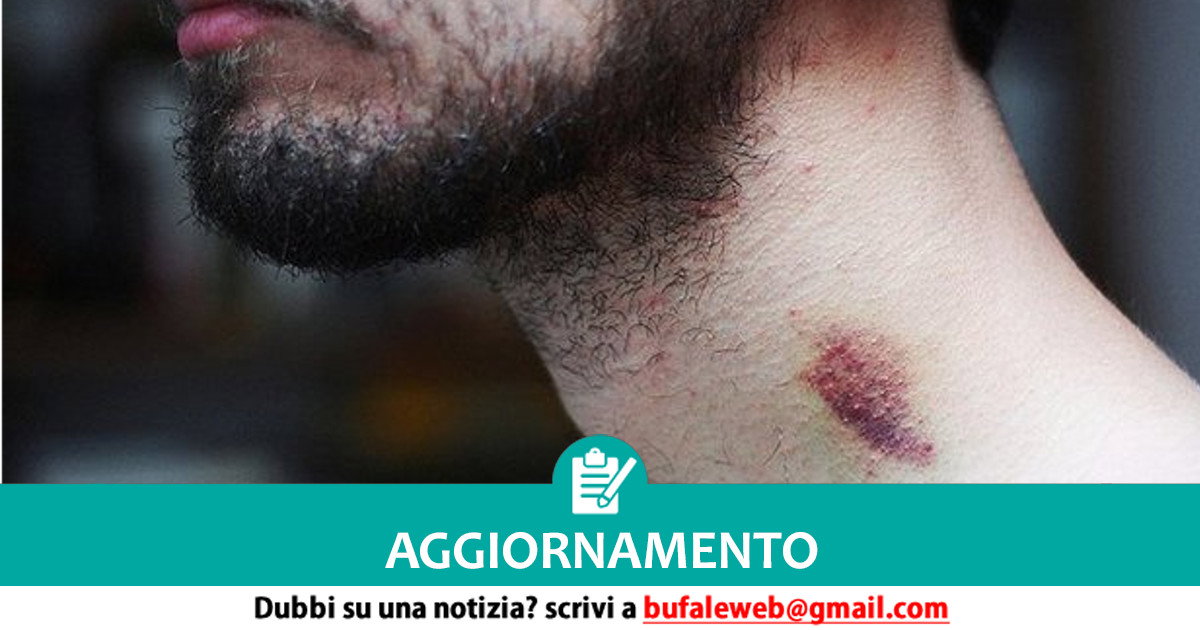 Dopo Quanto Si Muore Per Un Succhiotto