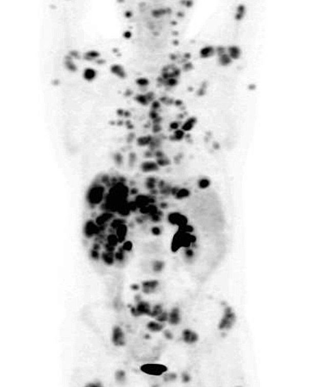 La cura del cancro? Non ancora article-post