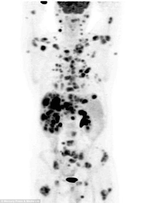 La cura del cancro? Non ancora