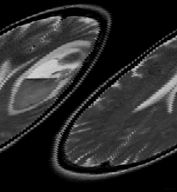 La dieta vegana che cura i tumori