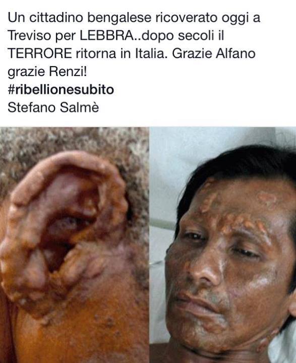 E dopo Ebola: La Lebbra! venghino siori e siore… article-post