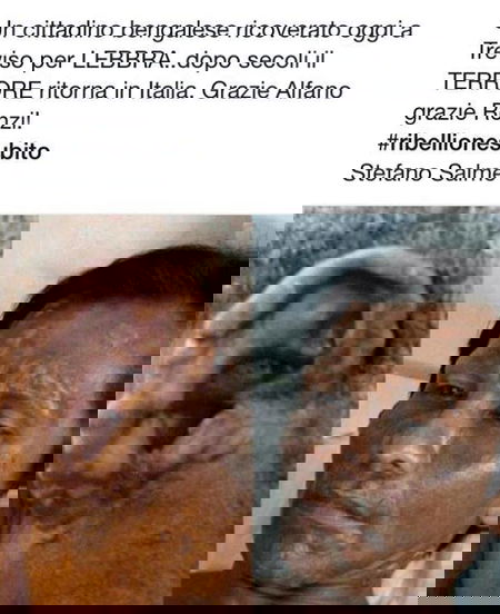 E dopo Ebola: La Lebbra! venghino siori e siore… article-post