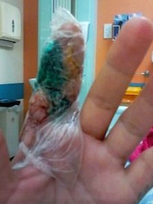 La falsa vedova nera e il dito amputato