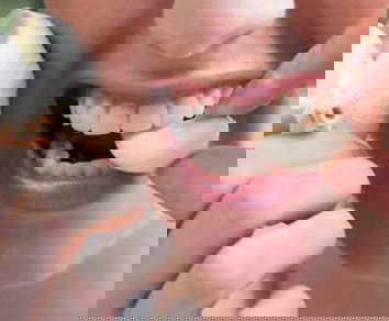 Aglio, cipolla e interiora contro i superbatteri