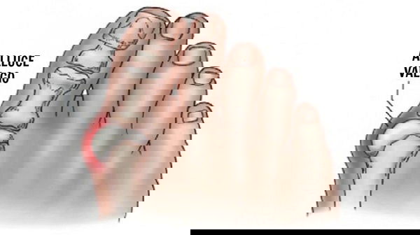 L’alluce valgo e la fuffa