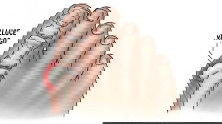 L’alluce valgo e la fuffa article-post