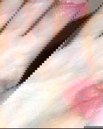 Curare il tumore senza chemio né interventi