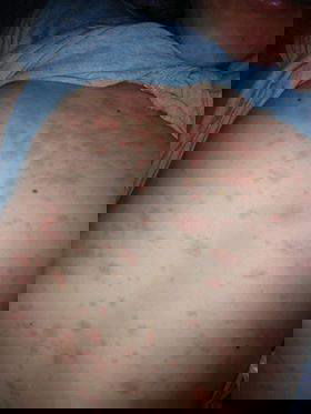 Morbillo, antibiotico e anonimato