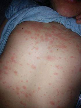 Morbillo, antibiotico e anonimato