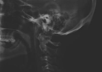 Le mutazioni ossee e gli smartphone