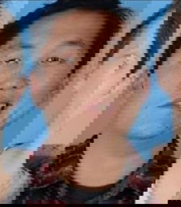 La paralisi di Bell e il vaccino Pfizer