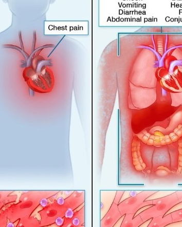 Il senatore, i vaccini e le miocarditi