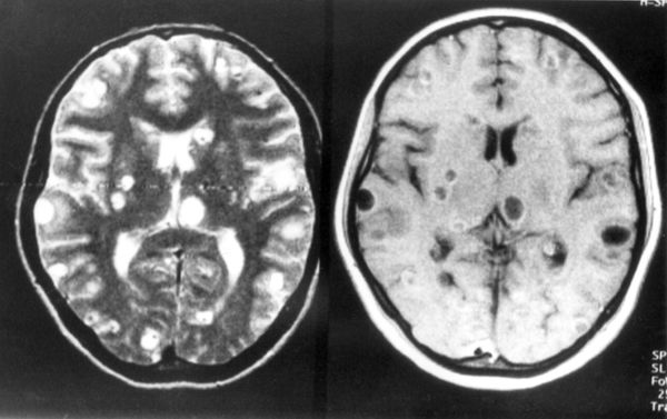 Il verme che infesta il cervello