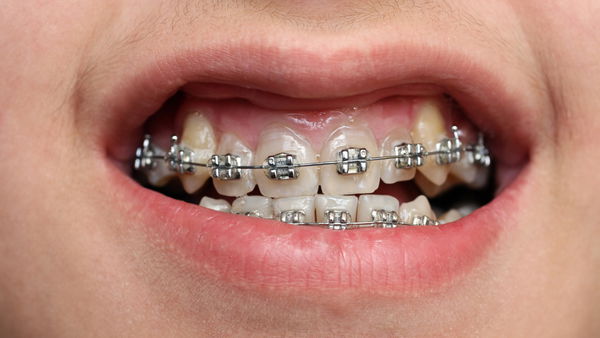La moda dell’apparecchio da denti finto