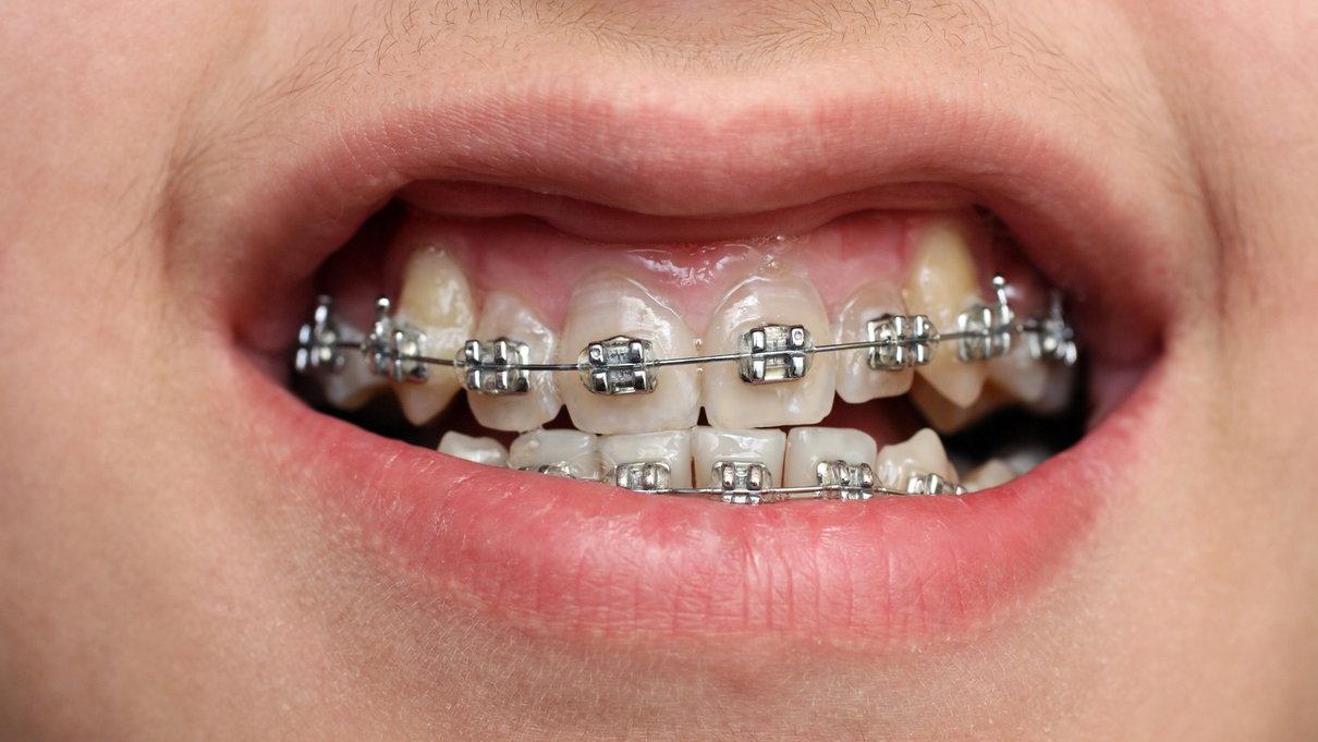 La moda dell’apparecchio da denti finto article-post